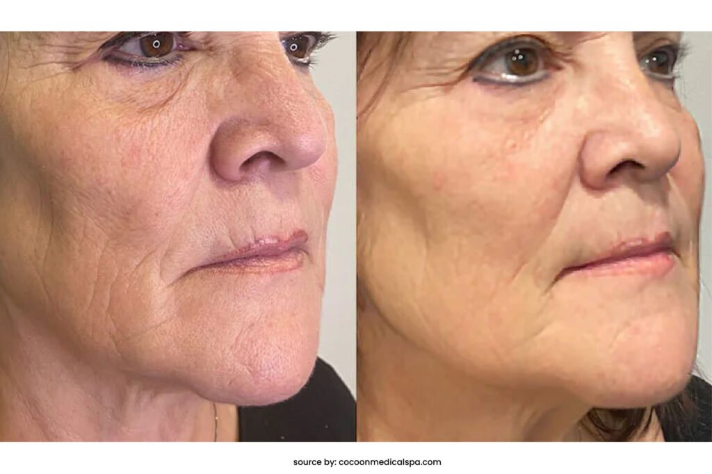 before after revok50